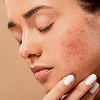 Acne-Treatment Pain Management