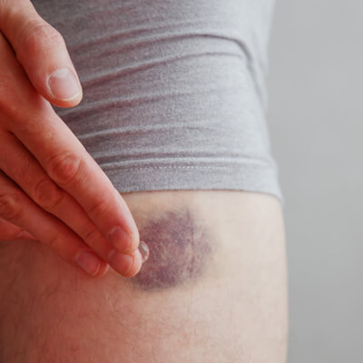 Wound-Healing Wound-Healing